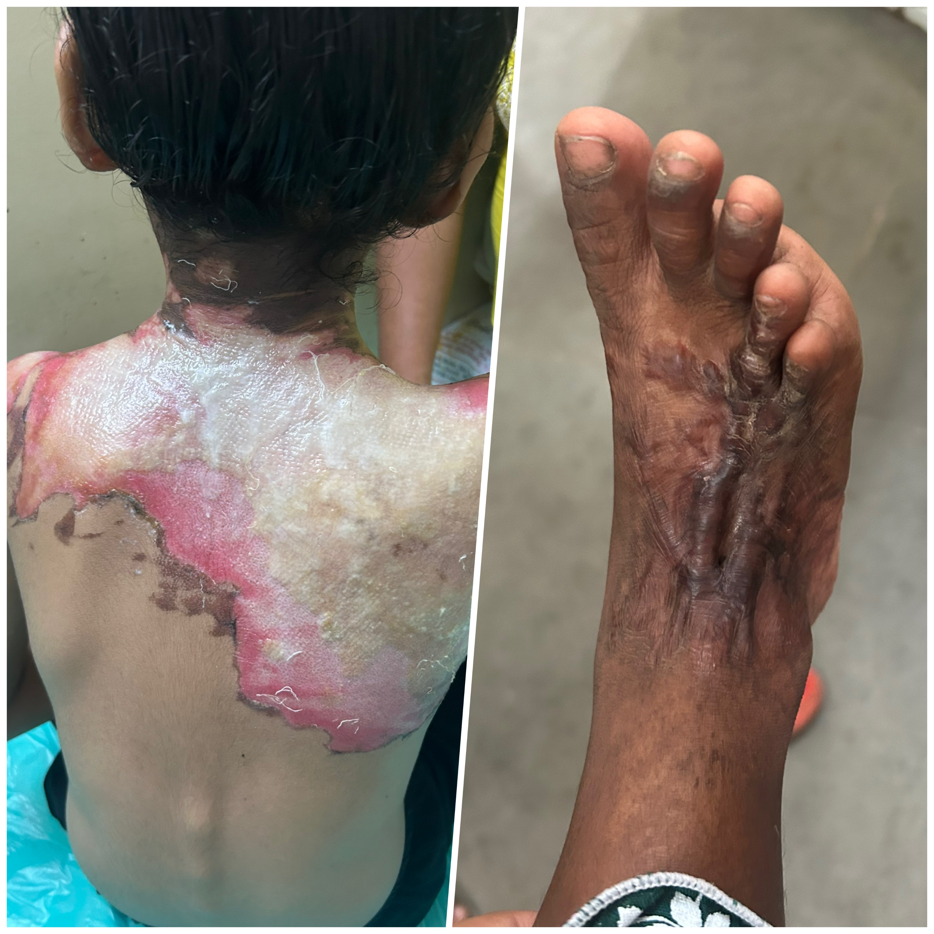 Burns and Contracture Surgery in Borivali
